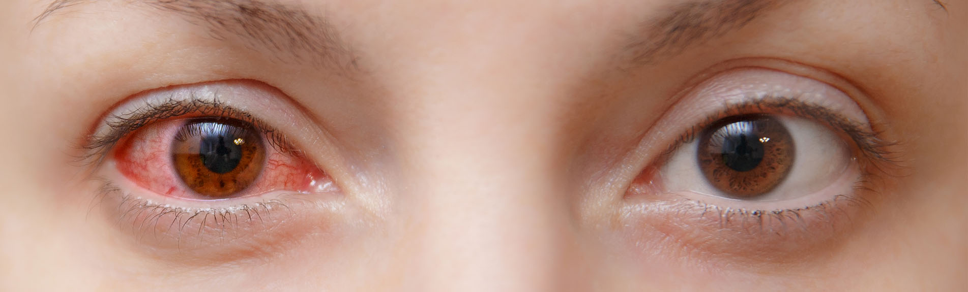 Conjunctivitis