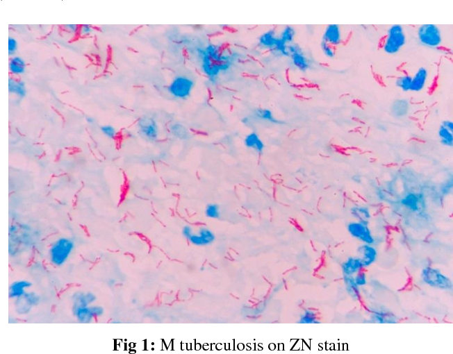pulmonary tuberculosis