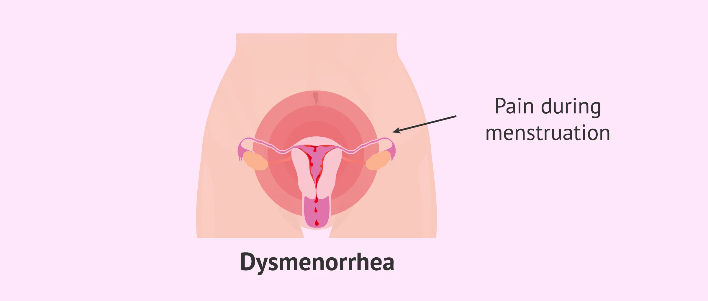 Dysmenorrhea